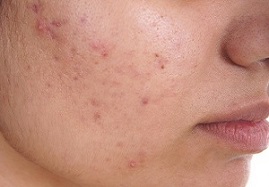 Skin diseases - Acne