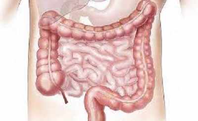 diverticulitis