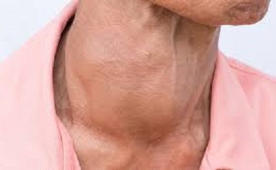 Hashimotos Thyroiditis