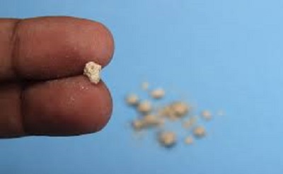 kidney stones