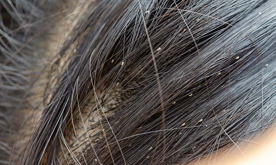 hair problems - lice