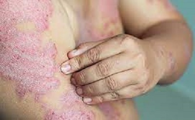 Multiple Psoriasis