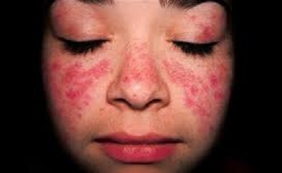 Systemic Lupus